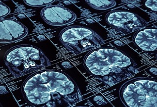 diversas imagens de um cérebro em resultado de exame de ressonância magnética